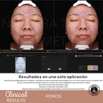 Peeling Enzimatico en Polvo Ideal para pieles sensibles y Dermapen