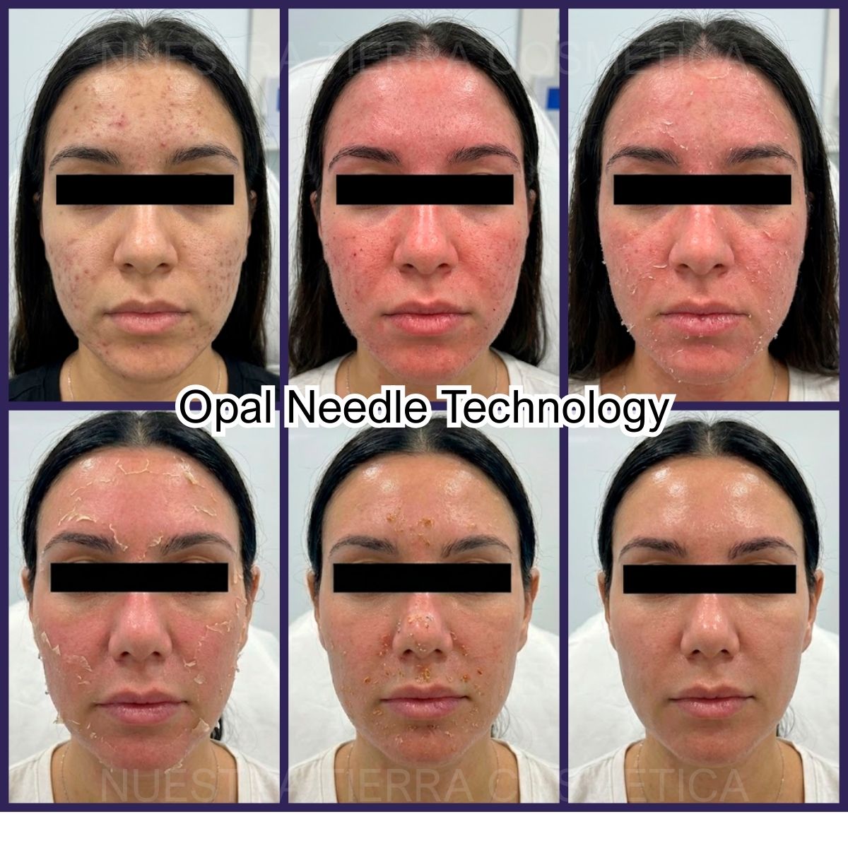 Kit Peeling New Skin Nueva Piel en 7 días sin ácidos Opal Needle Technology - Nuestra Tierra Cosmética Ancestral