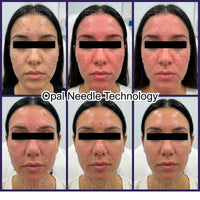 Kit Peeling New Skin Nueva Piel en 7 días sin ácidos Opal Needle Technology - Nuestra Tierra Cosmética Ancestral