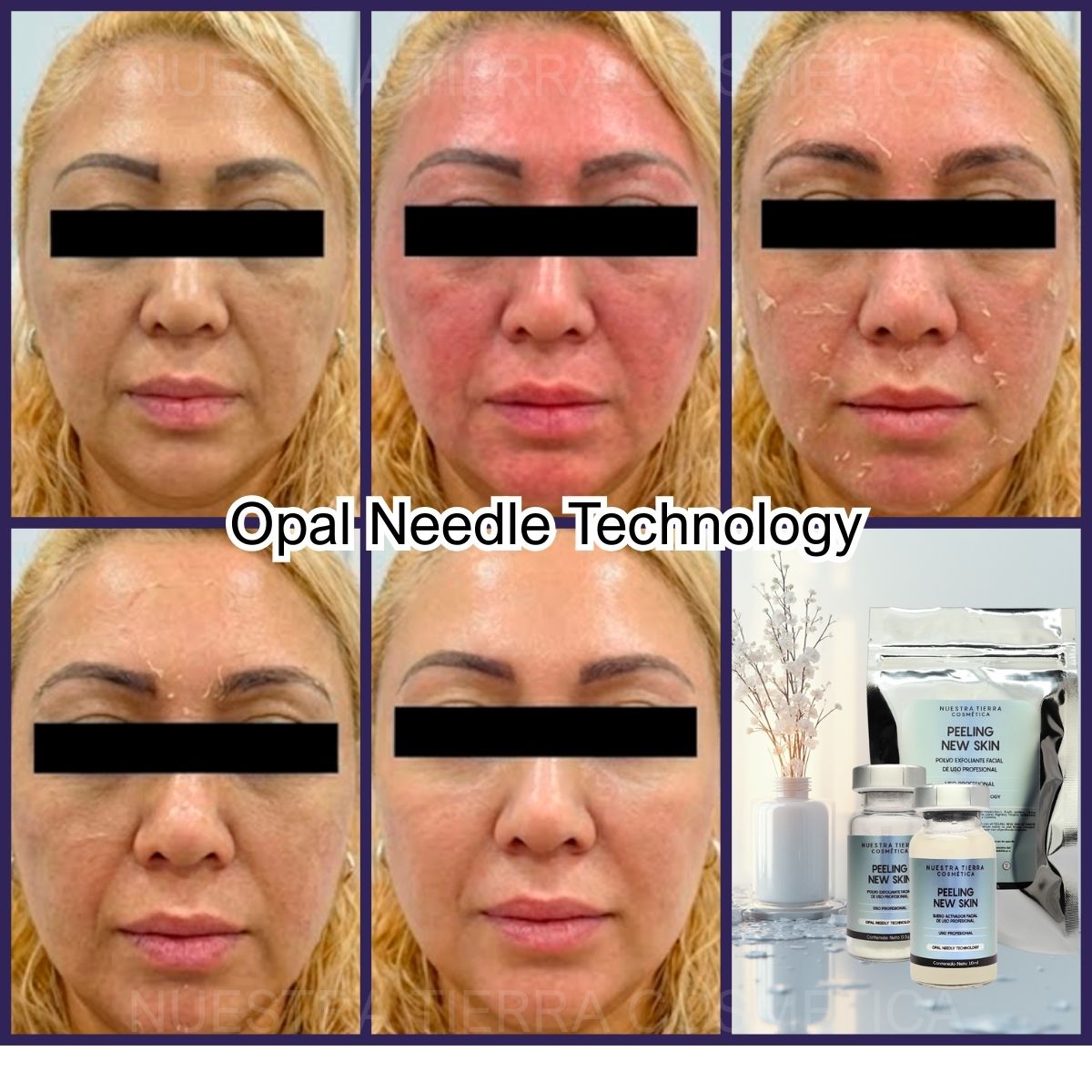 Kit Peeling New Skin Nueva Piel en 7 días sin ácidos Opal Needle Technology - Nuestra Tierra Cosmética Ancestral