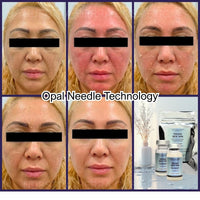 Kit Peeling New Skin Nueva Piel en 7 días sin ácidos Opal Needle Technology - Nuestra Tierra Cosmética Ancestral